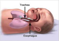A baby sleeping on its back illustrating the location of the trachea.