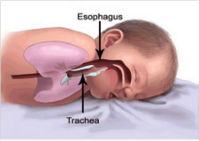 A baby sleeping on its stomach illustrating the location of the trachea.